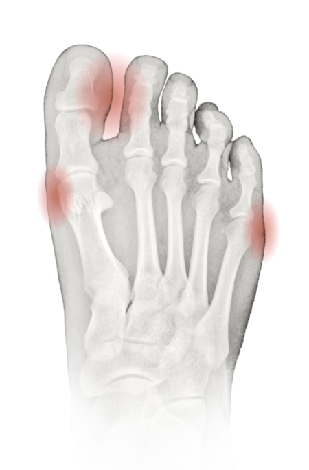 Wide feet X-ray diagram showing pain points